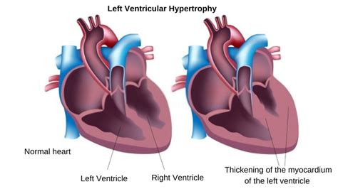left ventricular hypertrophy treatment